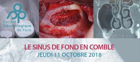 Le sinus de fond en comble